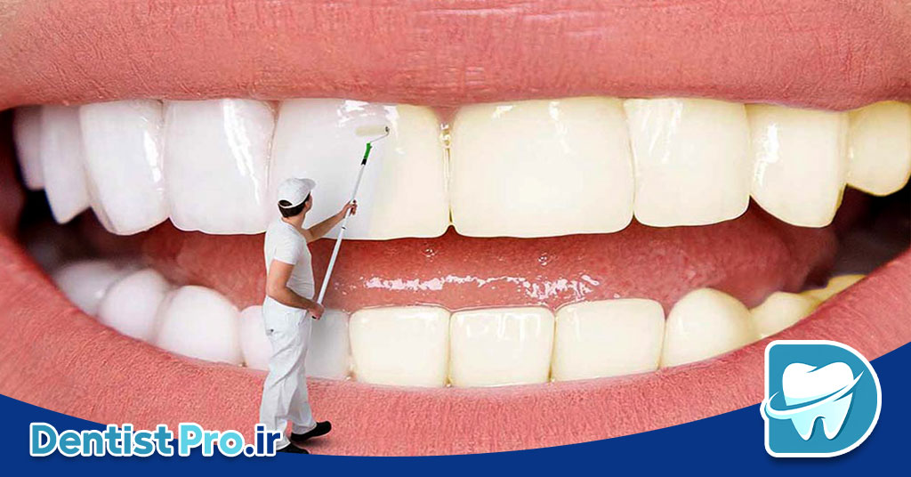 سفیدی دندان بدون بلیچینگ؛ راهکارهایی طبیعی و موثر برای لبخندی درخشان 28 سفیدی دندان بدون بلیچینگ؛ راهکارهایی طبیعی و موثر برای لبخندی درخشان