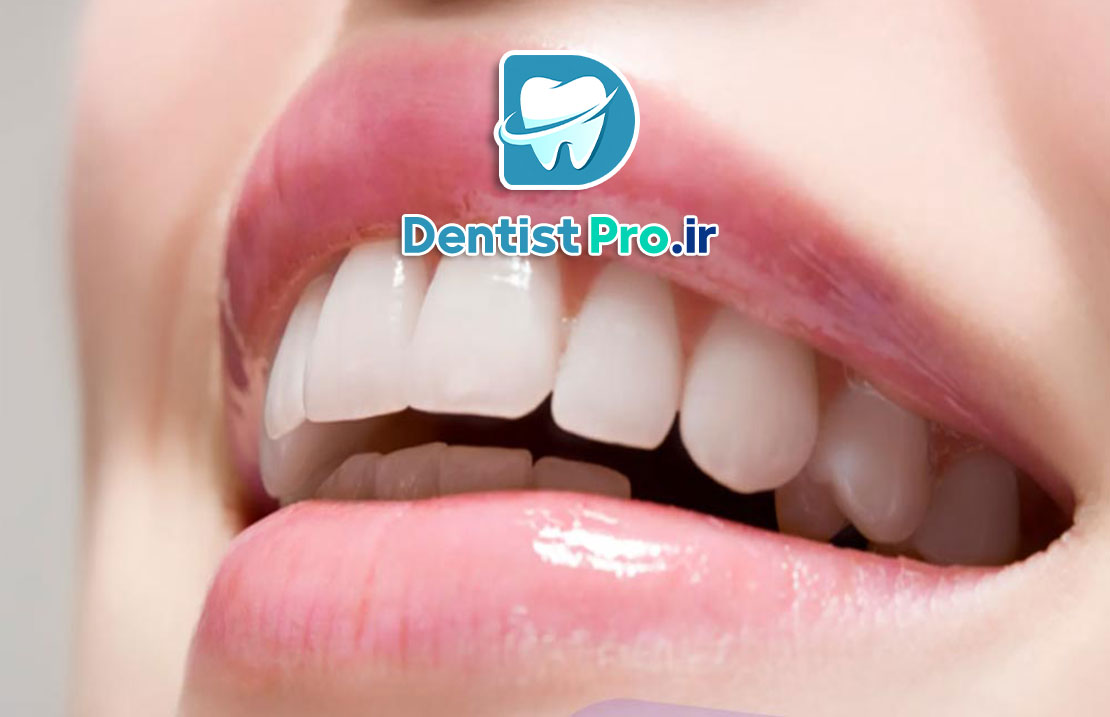 سفیدی دندان بدون بلیچینگ؛ راهکارهایی طبیعی و موثر برای لبخندی درخشان 25 سفیدی دندان بدون بلیچینگ؛ راهکارهایی طبیعی و موثر برای لبخندی درخشان