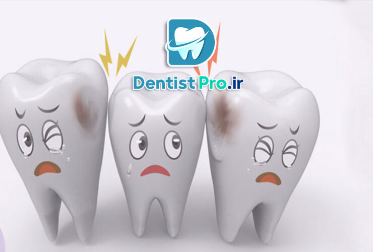 درمان پوسیدگی دندان شیری: اهمیت و روش‌های موثر برای حفظ سلامت دهان کودکان