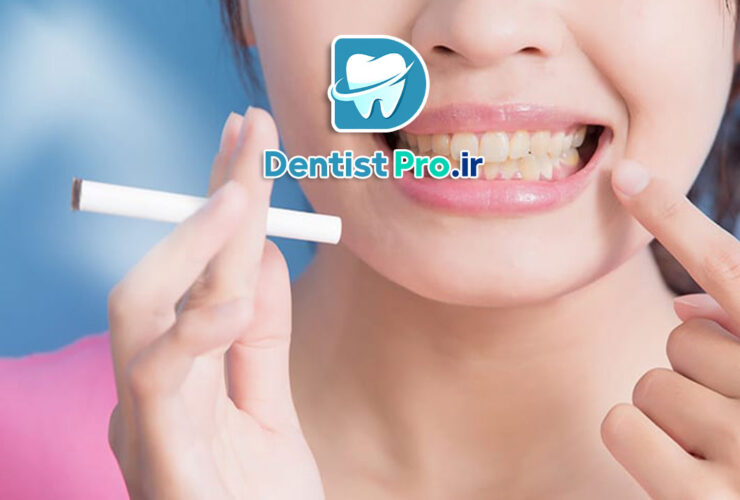 زرد شدن دندان بعد از ارتودنسی: علل، پیشگیری و راههای درمان 48 زرد شدن دندان بعد از ارتودنسی