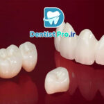 روکش زیرکونیا: بررسی کامل ویژگی‌ها، مزایا و کاربردها