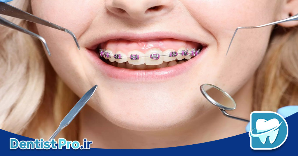 تفاوت ارتودنسی ثابت و متحرک: بررسی کامل روشها، مزایا و معایب 29 تفاوت ارتودنسی ثابت و متحرک: بررسی کامل روشها، مزایا و معایب