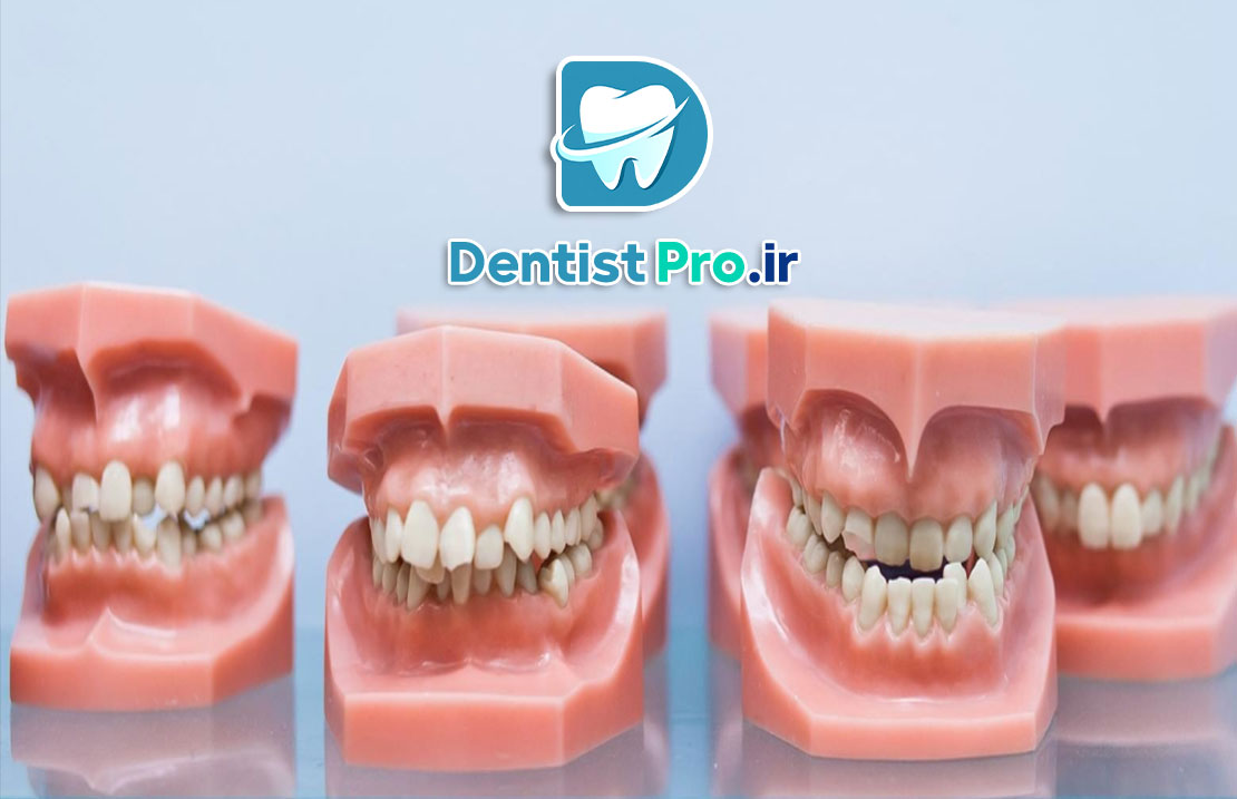 مال اکلوژن: بررسی جامع اختلالات قرارگیری دندانها و راههای درمانی 25 مال اکلوژن: بررسی جامع اختلالات قرارگیری دندانها و راههای درمانی