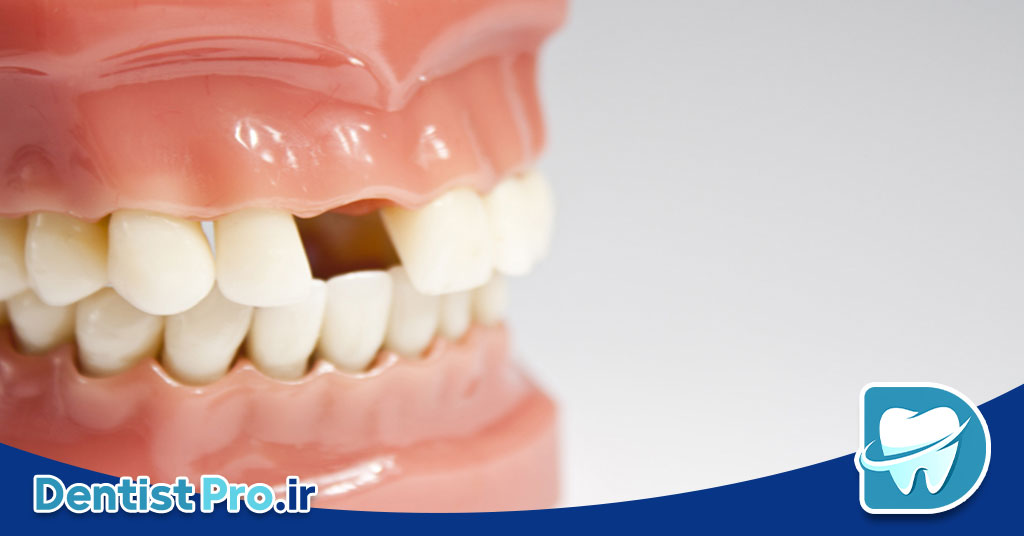 مال اکلوژن: بررسی جامع اختلالات قرارگیری دندانها و راههای درمانی 29 مال اکلوژن: بررسی جامع اختلالات قرارگیری دندانها و راههای درمانی