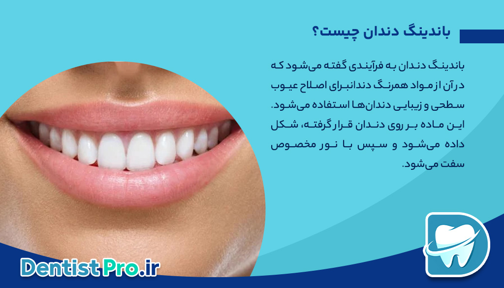 باندینگ دندان: روشی ساده و موثر برای اصلاح ظاهر دندان‌ها