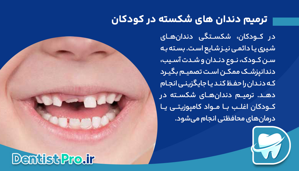 ترمیم دندان های شکسته؛ بازگرداندن لبخند شما با روشهای نوین 29 ترمیم دندان های شکسته؛ بازگرداندن لبخند شما با روشهای نوین