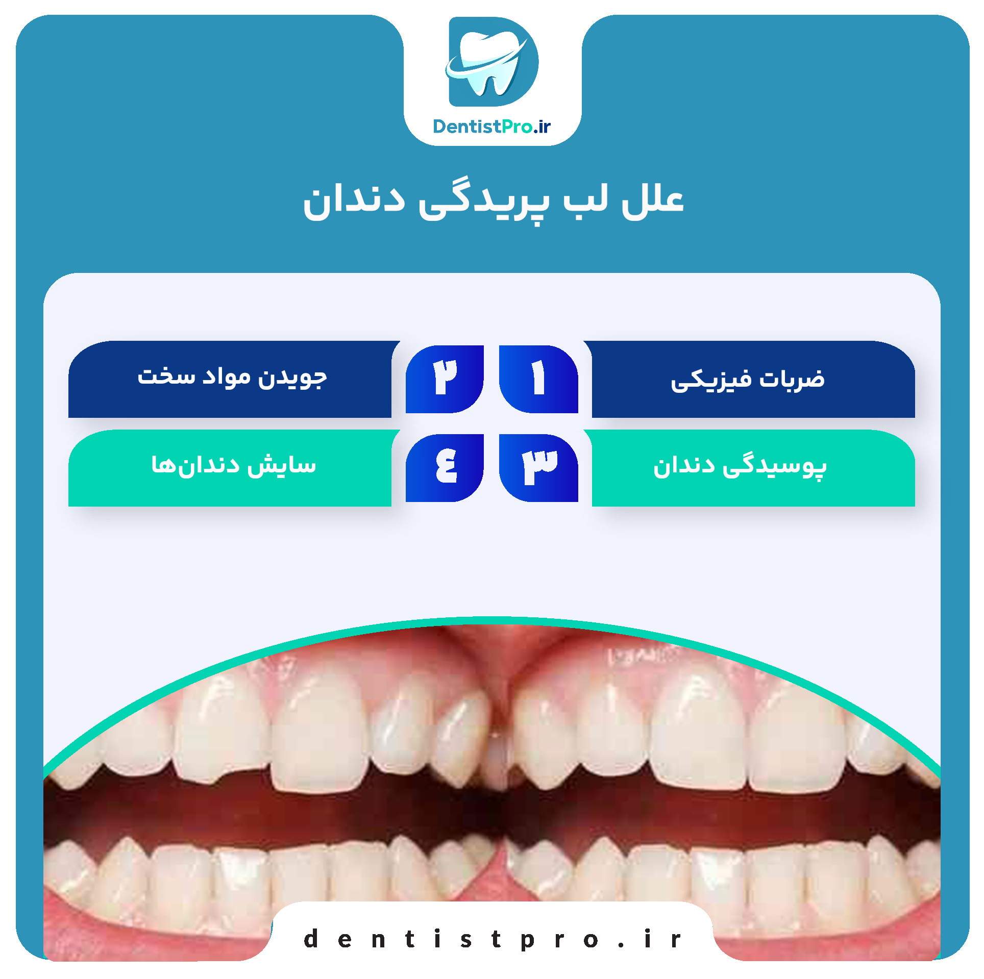 ترمیم لب پریدگی دندان: راهنمای کامل برای بازگرداندن زیبایی و سلامت دندان