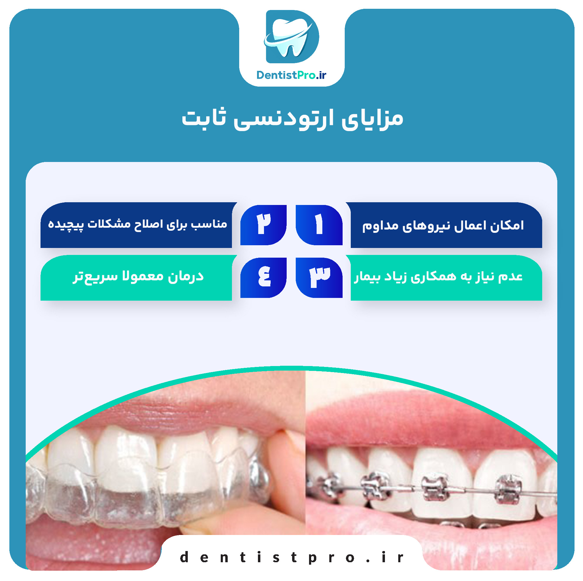 تفاوت ارتودنسی ثابت و متحرک: بررسی کامل روشها، مزایا و معایب 27 تفاوت ارتودنسی ثابت و متحرک: بررسی کامل روشها، مزایا و معایب