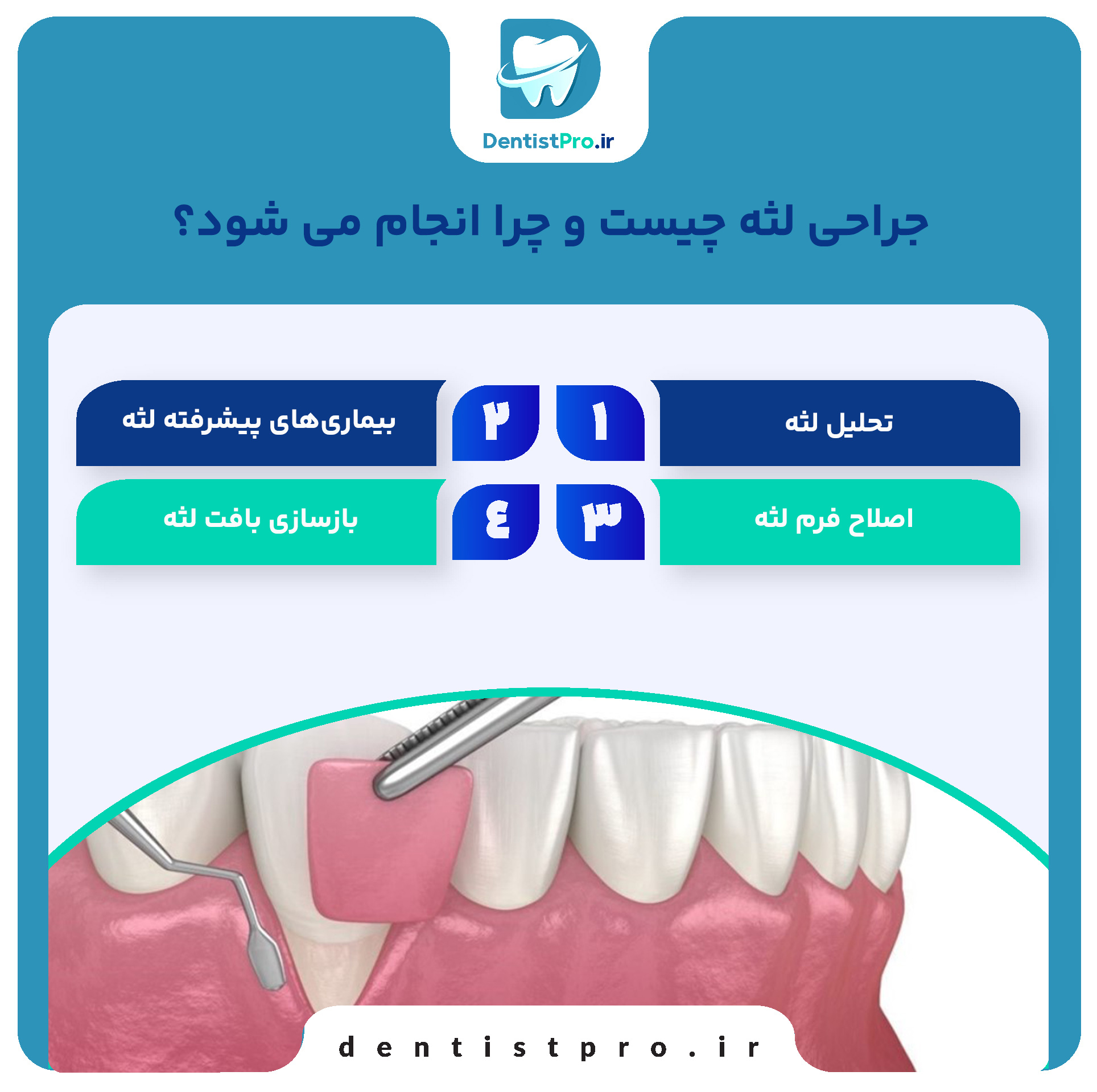 جراحی لثه به روش های نوین؛ تحول در سلامت و زیبایی دهان 26 جراحی لثه به روش های نوین؛ تحول در سلامت و زیبایی دهان