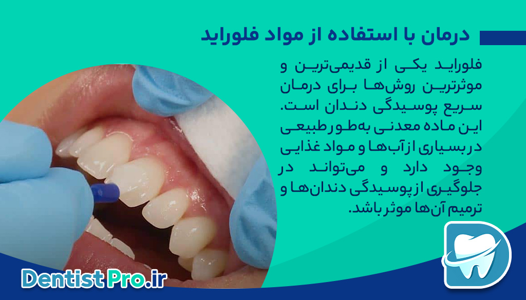 درمان سریع پوسیدگی دندان با روش های نوین+ 10 روش شگفت آور