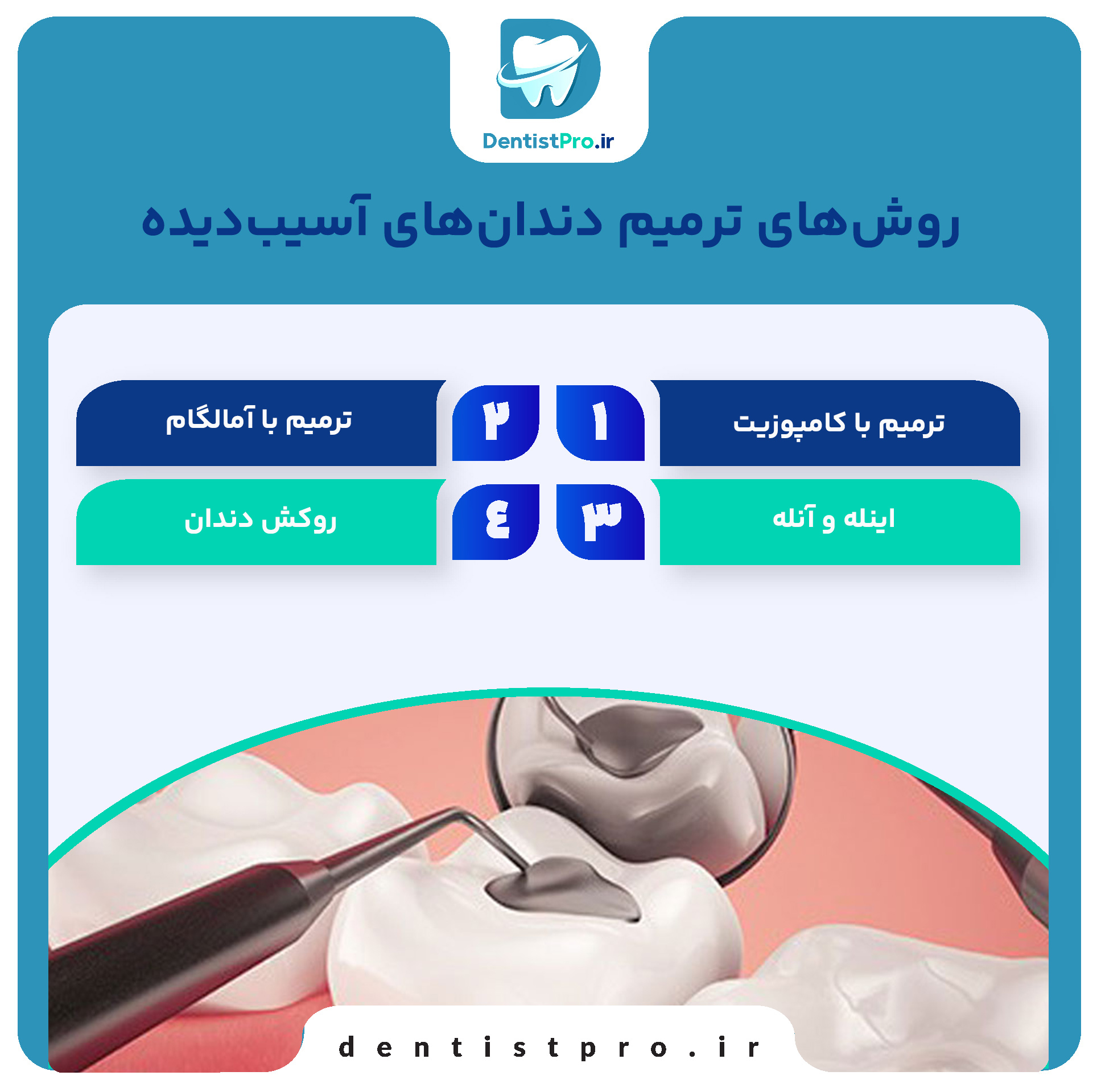 ترمیم دندان های آسیب دیده با مواد عالی؛ بازسازی لبخند با ماندگاری بالا