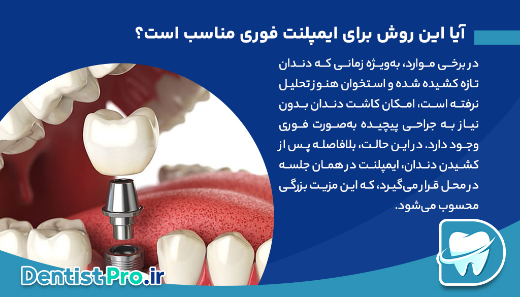 کاشت دندان بدون نیاز به جراحی پیچیده؛ لبخندتان را ساده و سریع بازسازی کنید 29 کاشت دندان بدون نیاز به جراحی پیچیده؛ لبخندتان را ساده و سریع بازسازی کنید