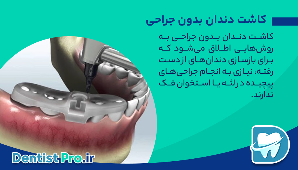 کاشت دندان بدون جراحی: راهی نوین برای بازسازی لبخند