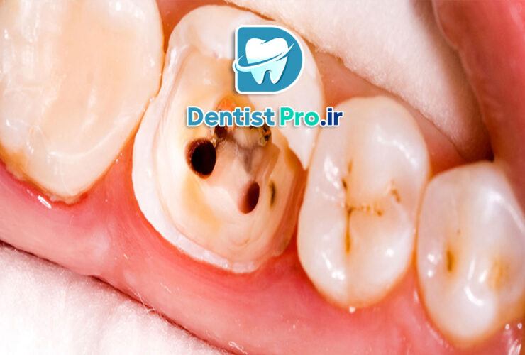 پرکردگی دندان عقب: روش‌ها، مزایا و نکات کلیدی