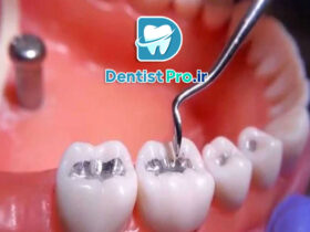 مزایای پرکردگی آمالگام: راهنمای جامع