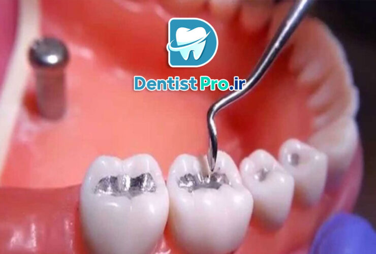 مزایای پرکردگی آمالگام: راهنمای جامع