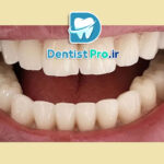 مزایای پرکردگی کامپوزیت دندان: چرا این انتخاب بهترین است؟