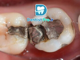 پرکردگی سرامیکی دندان: مزایا، مراحل و نکات ضروری