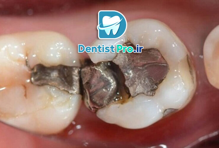پرکردگی سرامیکی دندان: مزایا، مراحل و نکات ضروری