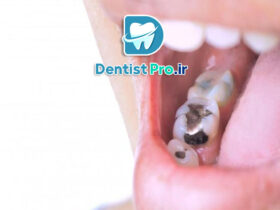 عوارض پرکردگی دندان: بررسی و تحلیل