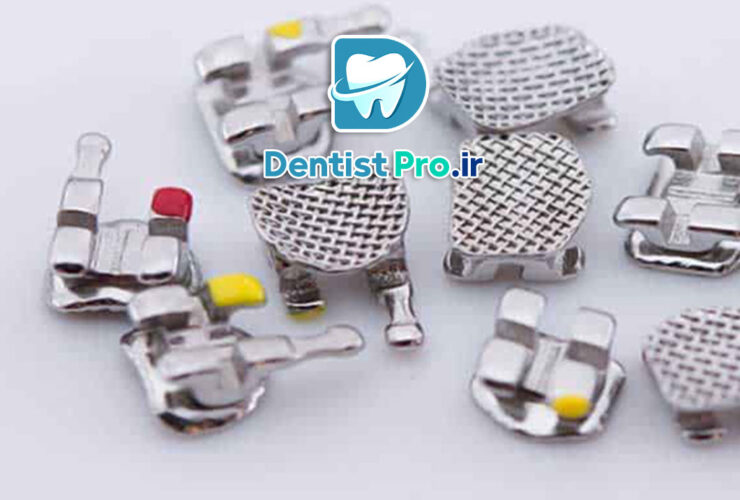 عوارض براکت های فلزی: بررسی و تحلیل 34 عوارض براکت های فلزی: بررسی و تحلیل