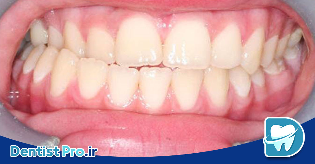 درمان کراس بایت با ارتودنسی