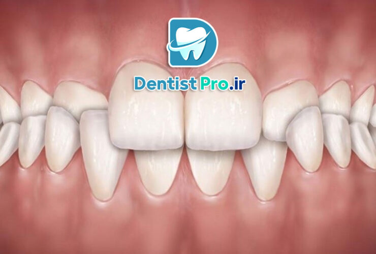 درمان کراس بایت با ارتودنسی 41 درمان کراس بایت با ارتودنسی