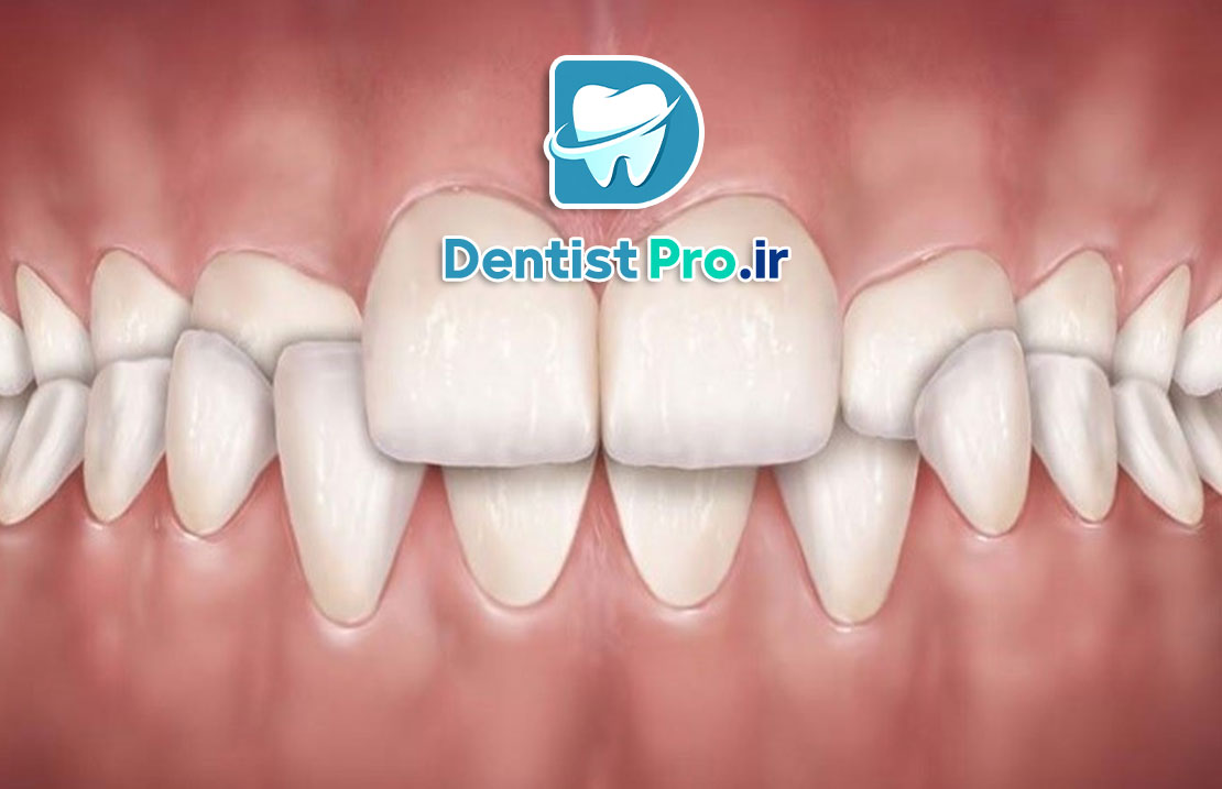 درمان کراس بایت با ارتودنسی