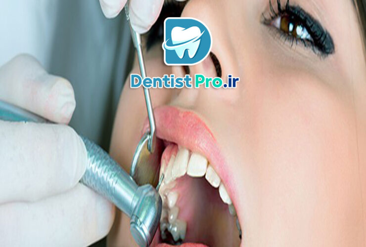 پرکردگی کامپوزیت دندان: راهنمای جامع