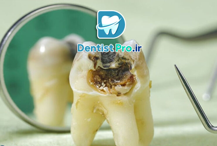 پرکردگی دندان برای جلوگیری از گسترش پوسیدگی: یک راهکار موثر برای حفظ سلامت دندان‌ها