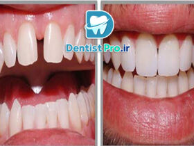 رفع فواصل دندان ها با کامپوزیت: روش‌ها، مزایا و نکات