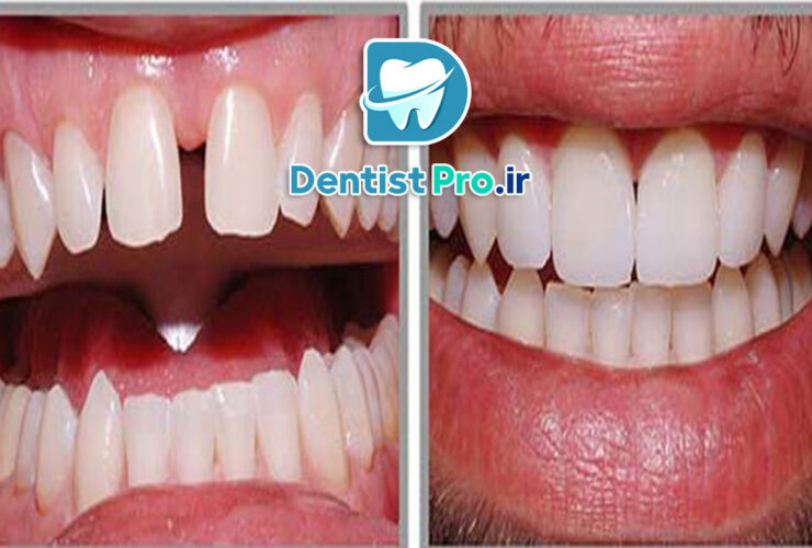 رفع فواصل دندان ها با کامپوزیت: روش‌ها، مزایا و نکات