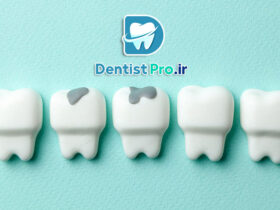 پرکردگی گلاس آینومر دندان: مزایا، ویژگی‌ها و کاربردها