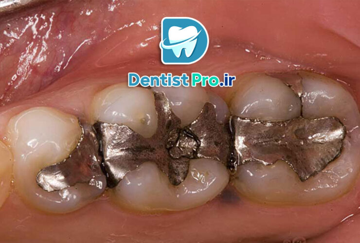 پرکردگی دندان با دوام بالا: گزینه‌ای برای ترمیم دائمی و موثر دندان‌ها