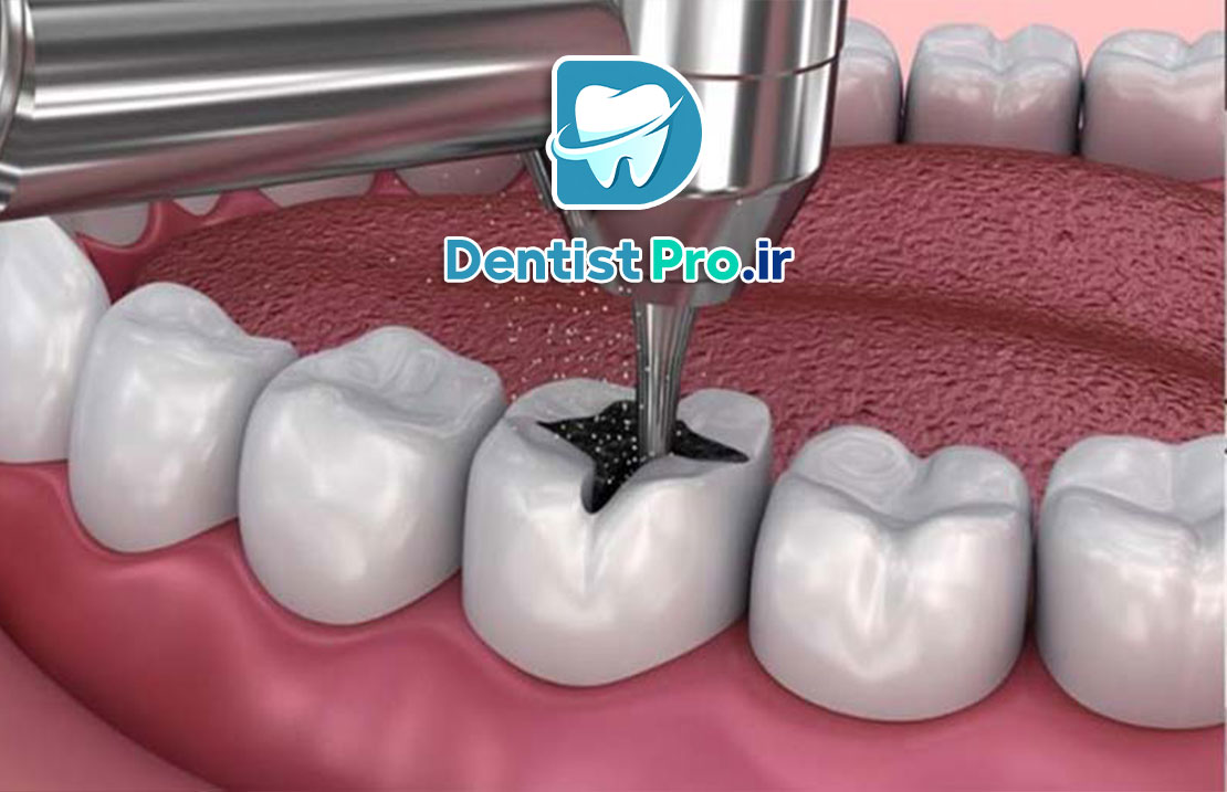 نکات مهم بعد از پرکردگی دندان: راهنمای جامع مراقبت از دندان‌های ترمیم شده