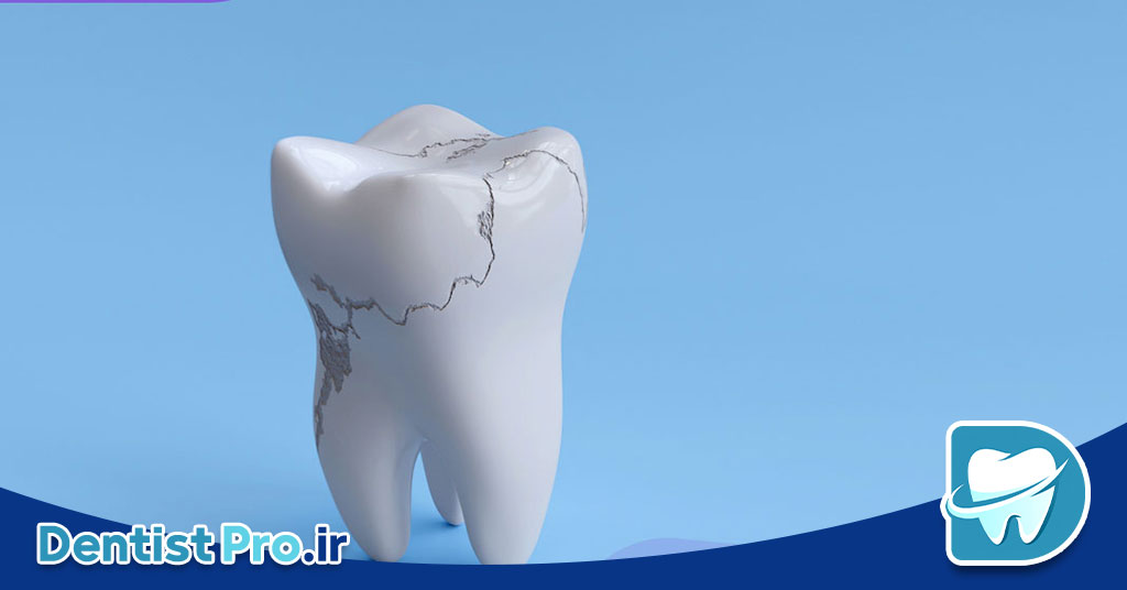 نکات مهم بعد از پرکردگی دندان: راهنمای جامع مراقبت از دندان‌های ترمیم شده