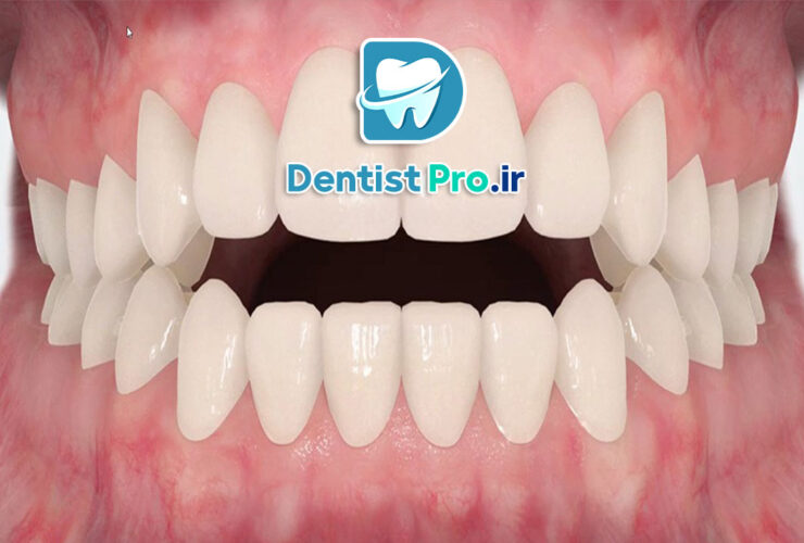 درمان اپن بایت با ارتودنسی: علل، تشخیص و روشهای درمان 48 درمان اپن بایت با ارتودنسی: علل، تشخیص و روشهای درمان