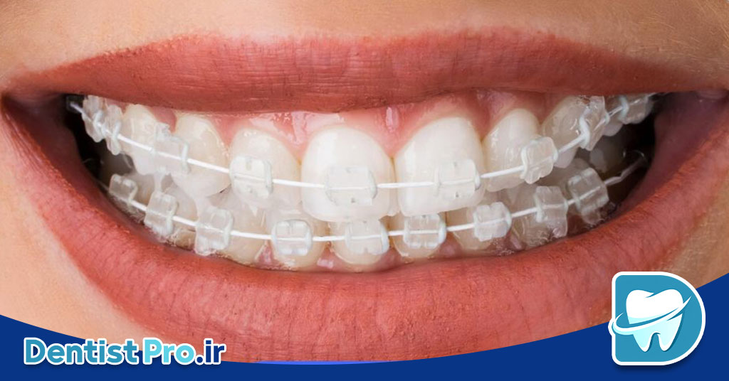ارتودنسی با براکت سرامیکی 28 ارتودنسی با براکت سرامیکی