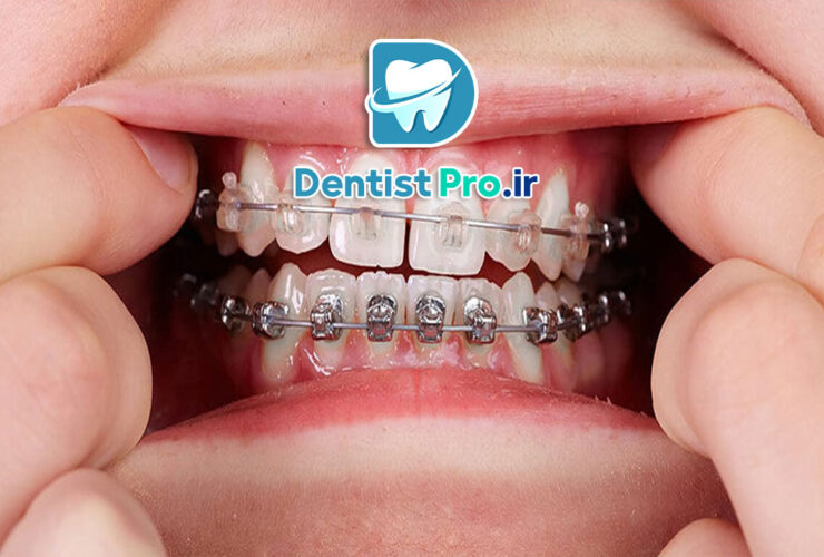 ارتودنسی با براکت سرامیکی 41 ارتودنسی با براکت سرامیکی