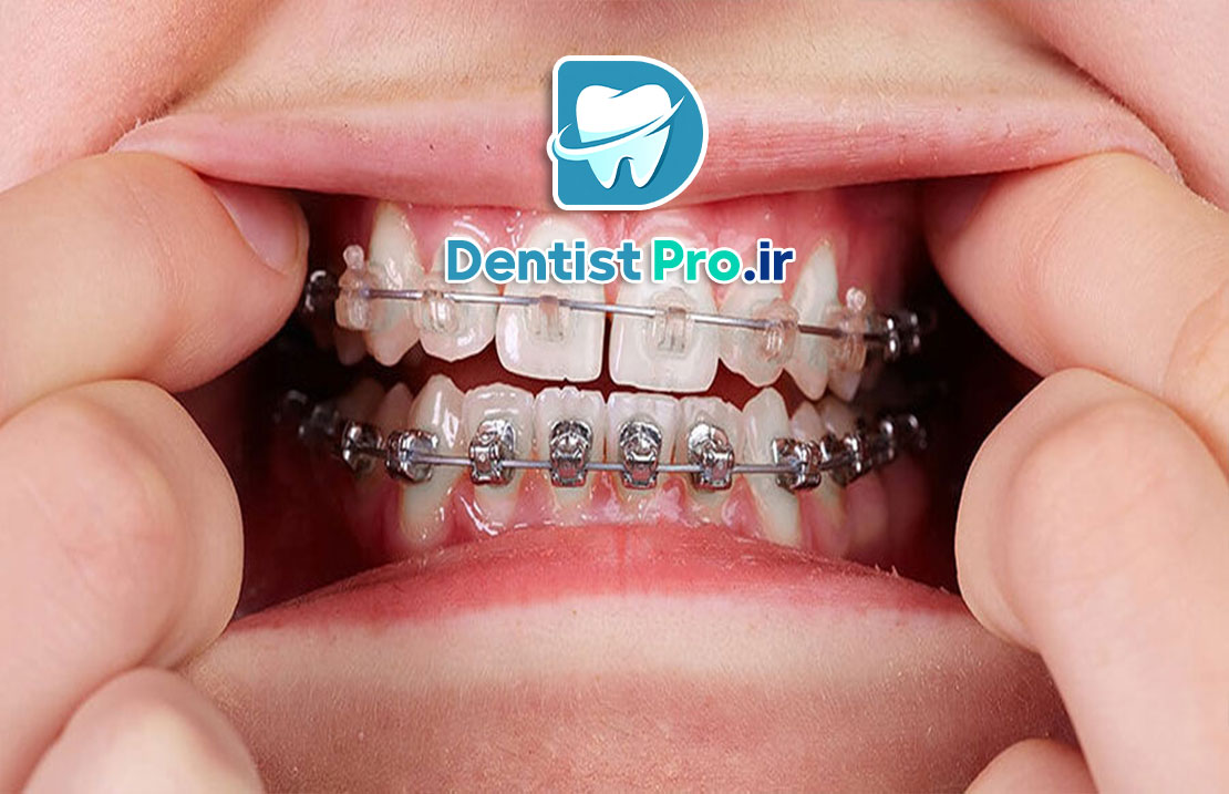 ارتودنسی با براکت سرامیکی 25 ارتودنسی با براکت سرامیکی