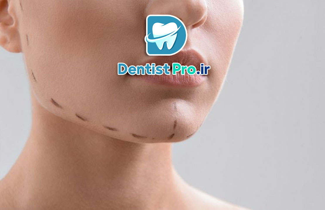 جراحی ارتوگناتیک: اصلاح مشکلات فکی و بهبود عملکرد و زیبایی 25 جراحی ارتوگناتیک: اصلاح مشکلات فکی و بهبود عملکرد و زیبایی