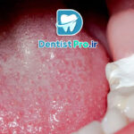 پرکردگی دندان بدون درد: راهی برای درمان بدون نگرانی