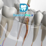 مراقبت های بعد از پرکردگی دندان: راهنمای کامل برای حفظ سلامت دندان‌ها