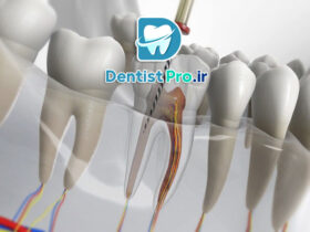 مراقبت های بعد از پرکردگی دندان: راهنمای کامل برای حفظ سلامت دندان‌ها