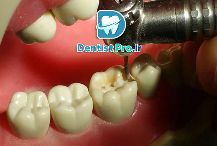 آمالگام نقره در دندانپزشکی: بررسی مزایا، معایب و کاربردها