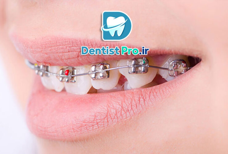 حل مشکلات افتادگی دندان با ارتودنسی: راهی برای بازگرداندن لبخند زیبا و عملکرد بهتر 41 حل مشکلات افتادگی دندان با ارتودنسی: راهی برای بازگرداندن لبخند زیبا و عملکرد بهتر