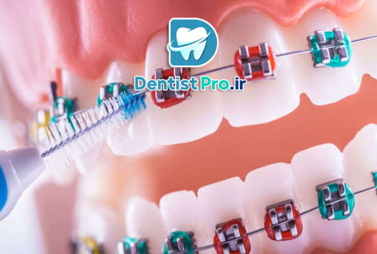 پوسیدگی دندان ها در ارتودنسی: علل، پیشگیری و درمان 27 پوسیدگی دندان ها در ارتودنسی: علل، پیشگیری و درمان