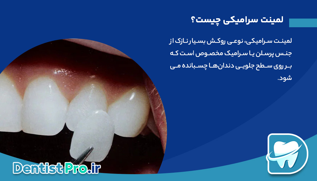 بررسی جامع دوام لمینت سرامیکی: زیبایی ماندگار برای لبخند شما