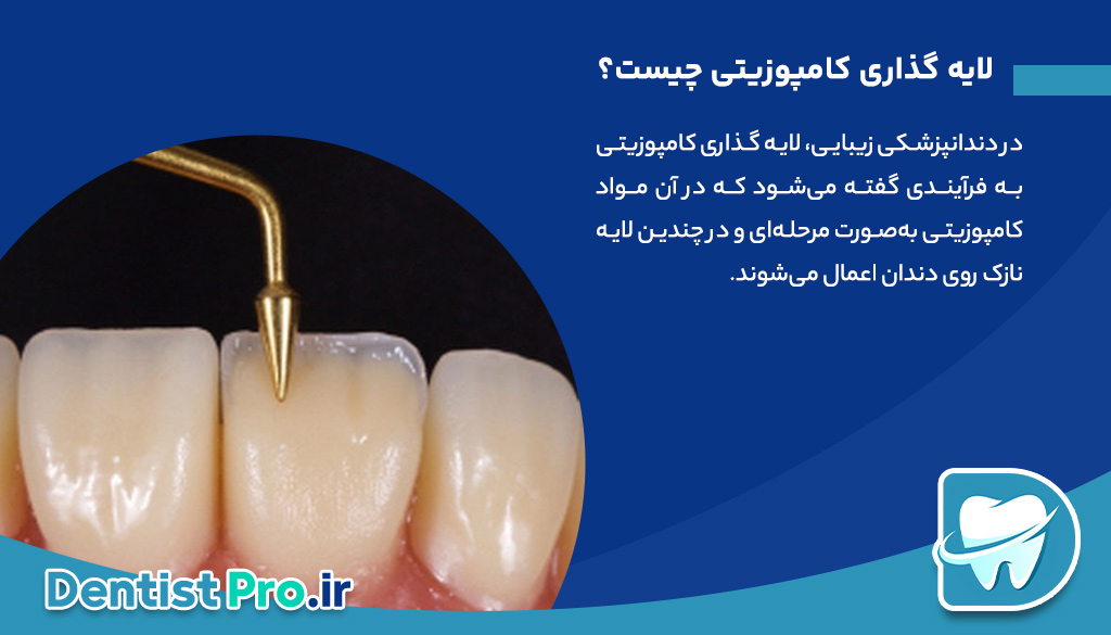 لایه گذاری کامپوزیتی؛ تکنیکی حرفه‌ای برای زیبایی و دوام دندان‌ها