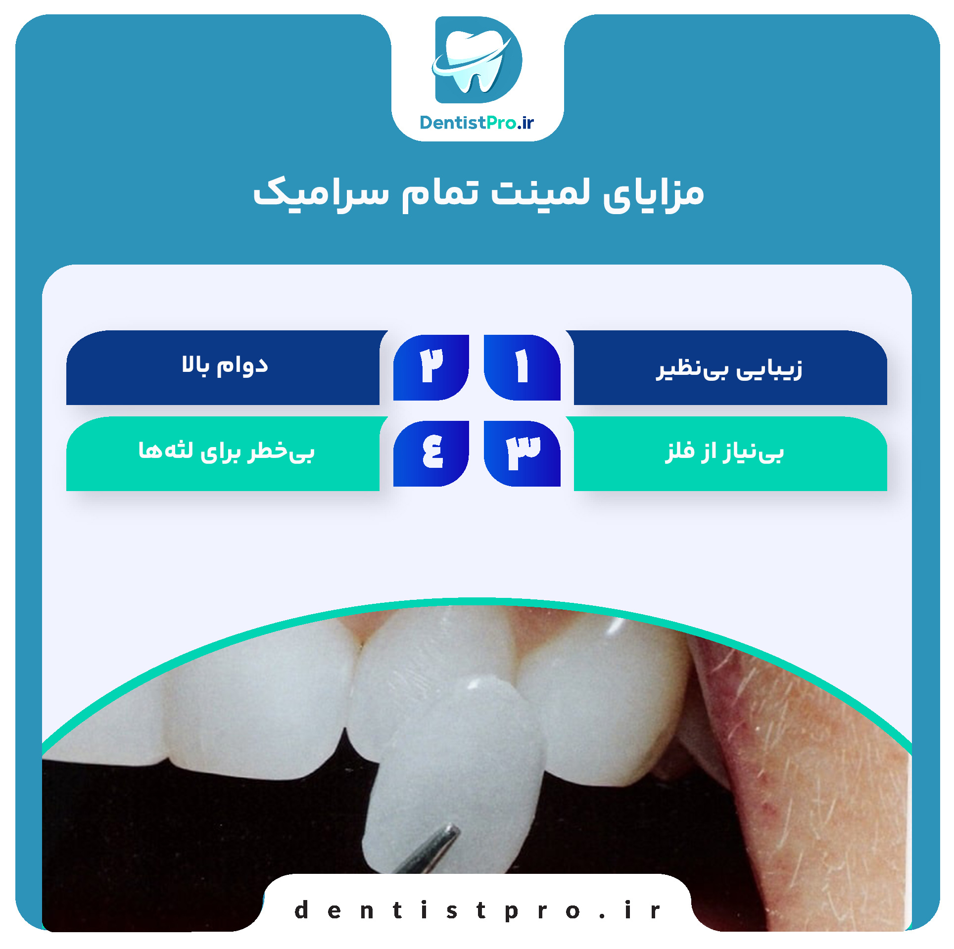 لمینت تمام سرامیک: راهکاری حرفه‌ای برای لبخندی درخشان و طبیعی